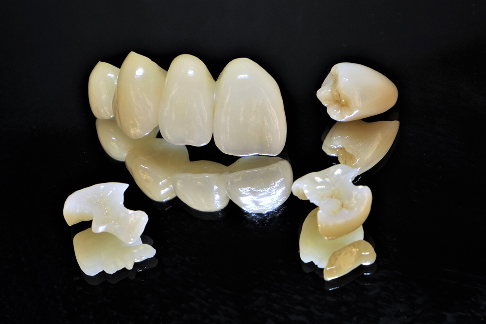 金属を一切使わない「メタルフリー治療」