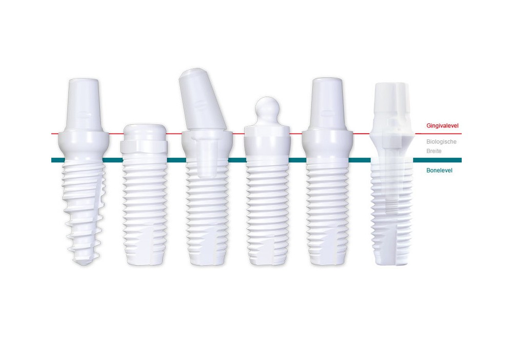 メタルフリーのジルコニアインプラント