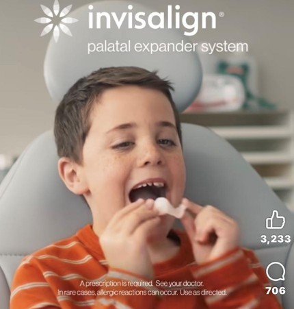 パラタルエキスパンダー（上顎拡大装置）