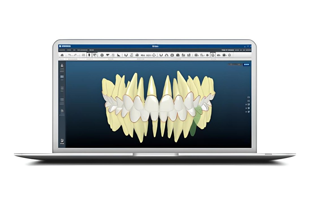 インシグニア矯正（カスタムブラケット矯正）